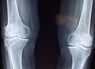 Czy wkładki ortopedyczne leczą?