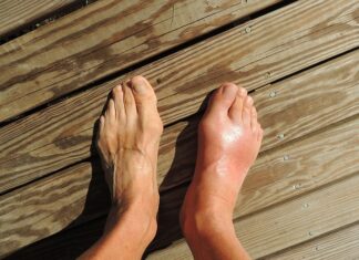 Jak wygląda stopą z płaskostopiem?